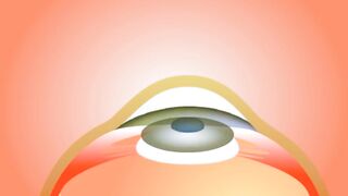 What is Cataract ?