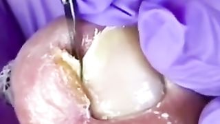 Nail inflamacion
