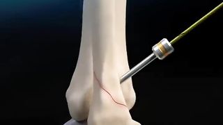 Ankle joint Fibula Bone Fracture Surgery 3D Animatio.