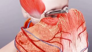 Face Skin Graft 3D Animation