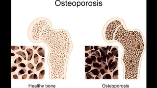 degenerative osteoporosis