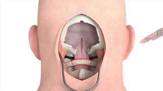 Craniectomy brain surgery - 3D animation