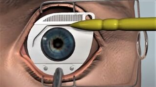 LASIK eye surgery - 3D animation