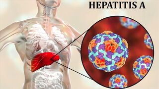 Hepatitis A symptoms causes diagnosis & treatment