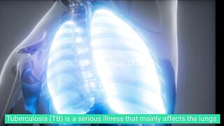 Tuberculosis Infectious Disease
