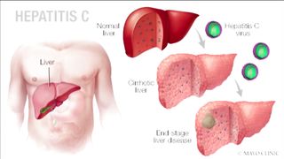 Hepatitis C symptoms causes diagnosis & treatment