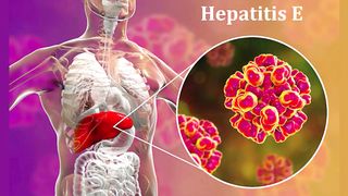Hepatitis E symptoms, causes, diagnosis & treatment