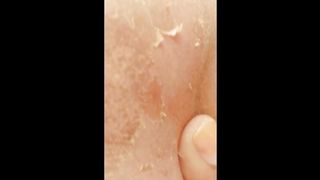 Pegmentation real story 2