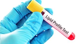 Lipid profile test explained