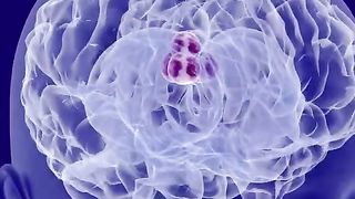 Brain tummers| medical| nursing|health|