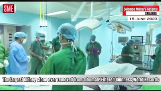 World’s largest and heaviest kidney stone removed from SriLankan man