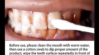 Dent , soins~Tooth care