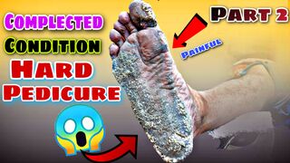 Hard complicated condition pedicure,Remove dead skin
