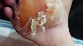 Pedicure, Complecated and carefully Remove, Crusty skin tutorial