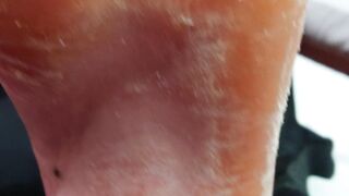 Huge Fissure pedicure, Remove crusty skin on Heel