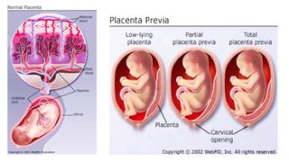 Placenta Previa symptoms, causes, diagnosis & treatment