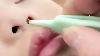 Accumulated nasal discharge