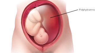 Polyhydramnios symptoms, causes, diagnosis & treatment