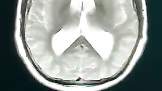 Video X-RAY cancer and hidrosepalus