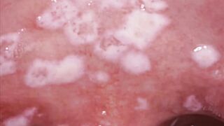 Oral Thrush overview