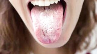 Oral & breast thrush symptoms, causes, diagnosis & treatment