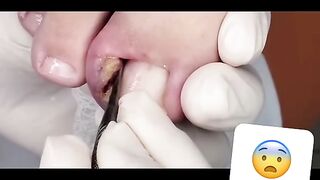 Ingrown toenail removal