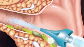 | Ear cleaning#Trend season channel #shortvide