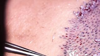 Hair implant procedure