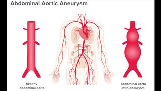 AAA symptoms, causes, diagnosis & treatment