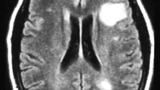 Multiple Sclerosis overview