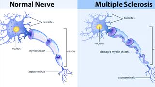 Multiple Sclerosis symptoms, causes, diagnosis & treatment