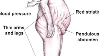 Cushing's Syndrome overview