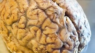 Infection on the human brain