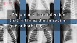 Understanding Pneumonia