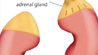 Pheochromocytoma overview