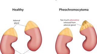 Pheochromocytoma symptoms, causes, diagnosis & treatment