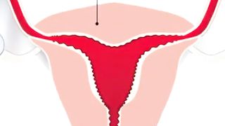 Vaginal Candidiasis overview