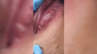 Satisfying Pimple Popping Splinter Blackhead Removing Tiktok compilation 1