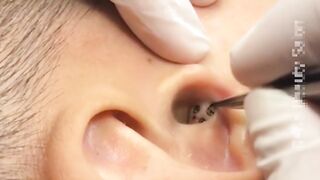 Deep removal of black head in the ear