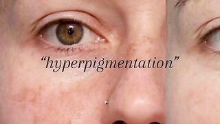 Skincare routine for hyperpigmentation
