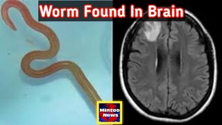 Live worm found in Australian woman's brain