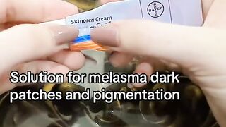 Solutions for melasma dark pitches and pigmentation