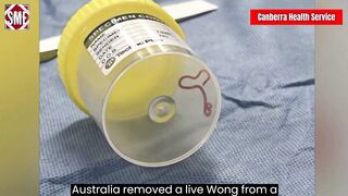 Live worm found in Australian woman's brain 2