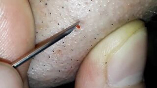 trending ????GIANT NEEDLE REMOVES #