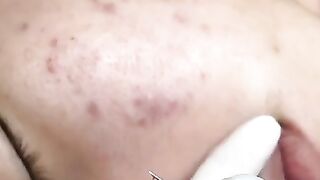 Ultimate Pimple Popping Extravaganza: Clear Skin Transformation