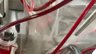 Bypass , open heart surgery