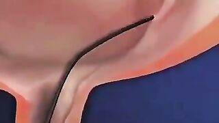 هذه هي الطريقة التي يزيل بها الأطباء حصوات الكلى
