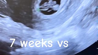"Eco Baby: Ascoltiamo il Battito del Piccolo in Pancia della Mamma"