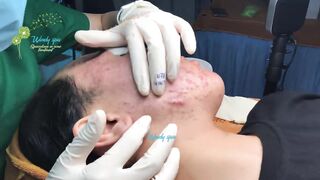 WOW OMG !! Satisfying Pimple Popping