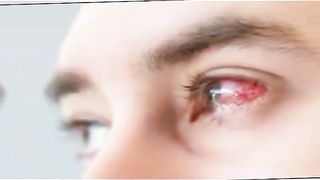 Eye flue virus.
